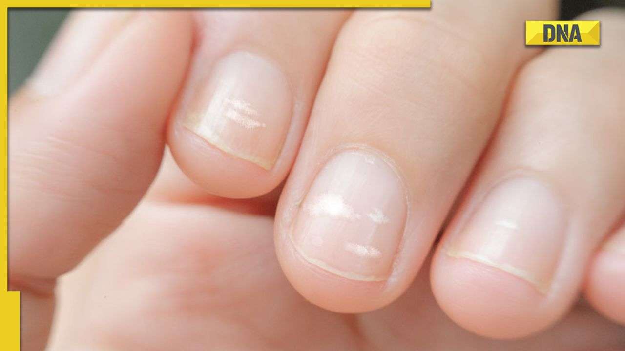 White spots on nails: Causes and treatment options | White spots on nails:  नाखून में सफेद निशान दिखते हैं तो आपको हो सकती है ये बीमारी