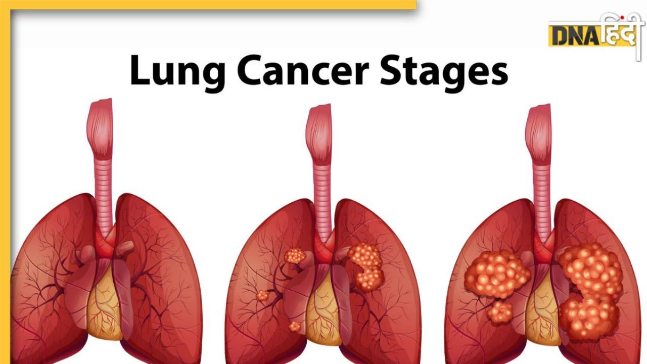 Lung Cancer: फेफड़ों को गला देती हैं ये 3 चीजें, लंग्स कैंसर से बचा सकते हैं ये 5 उपाय