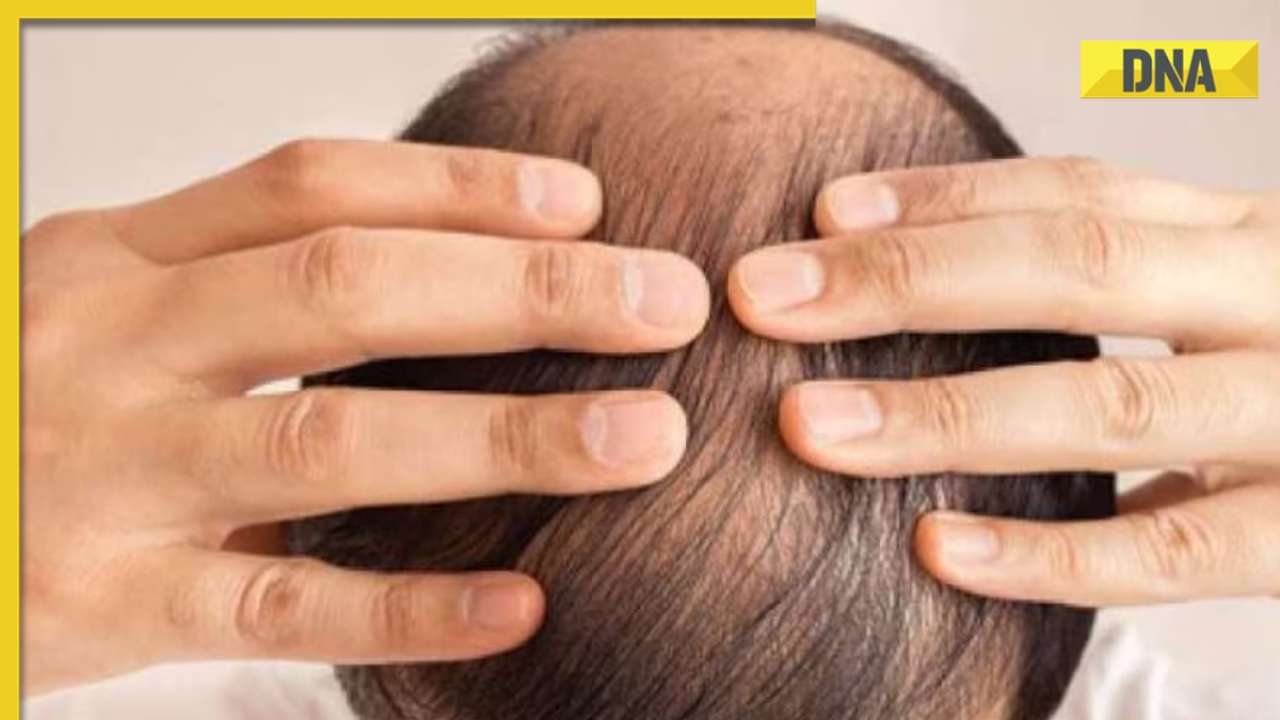 Suffering from hair loss? Here are 5 home remedies that may help