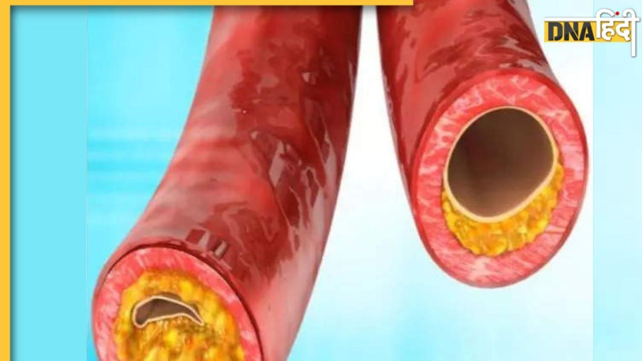 Bad Cholesterol: इन गलतियों से नसों के अंदर जम जाती है वसा, बैड कोलेस्ट्रॉल बढ़ा देता हार्ट अटैक से लेकर स्ट्रोक तक का खतरा