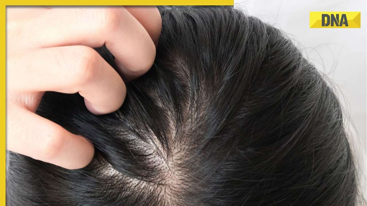 Itchy Hair Scalp 5 Worrisome Signs of Scalp Folliculitis Check Its  Treatment