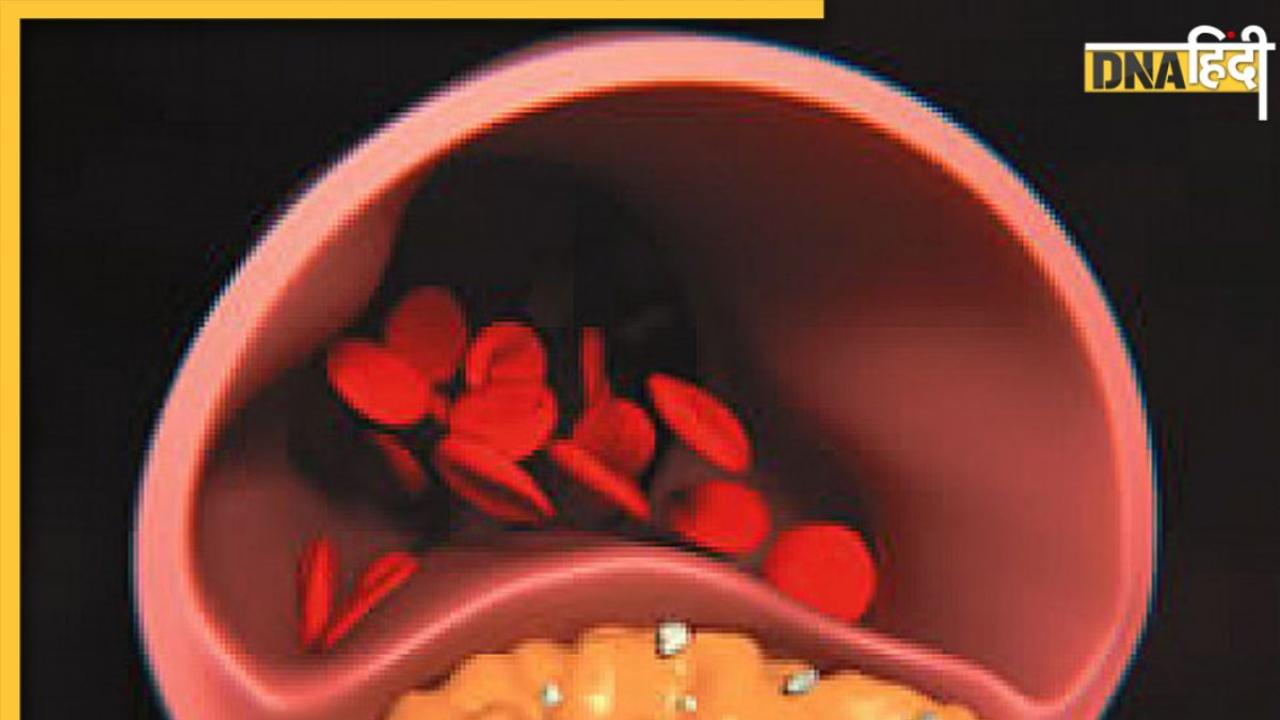 Reduce Cholesterol: नहीं छोड़ीं ये 6 आदतें तो दवा खाकर भी कम नहीं होगा बैड कोलेस्ट्रॉल, नसों की ब्लॉकेज ले लेगी जान