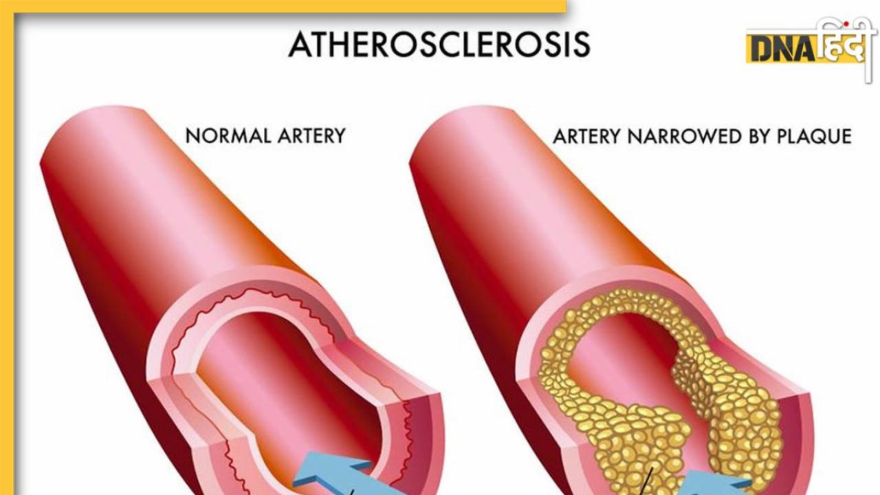 High Cholesterol Remedy: नसों में खून का दौरा बढ़ा देंगी ये 9 चीजें, ब्लड में जमा फैट पिघलने से खुलेंगी नर्व्स 