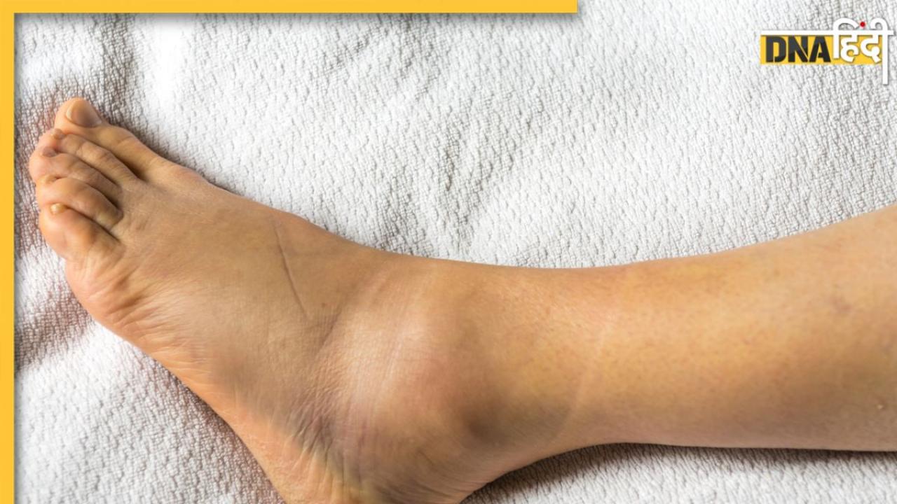 Swollen Ankles-Feet: एड़ियों और पैरों मे हो रही सूजन? समझ लें शरीर में पल रही हैं ये गंभीर बीमारियां