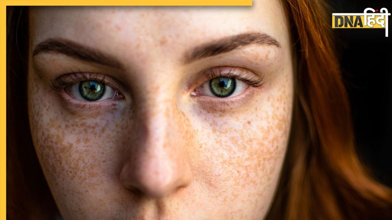 Thyroid Symptoms Of Skin: चेहरे पर जमे दाग-धब्बों को पिंपल समझने की न करें गलती, बढ़ते थायराइड का हो सकते हैं ये संकेत