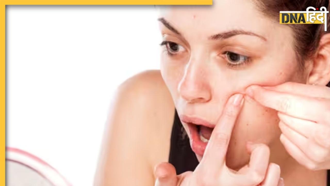 Acne Free, ग्लोइंग स्किन के लिए गुलाब जल के साथ मिलाकर लगाएं ये एक चीज, हफ्ते भर में दिखने लगेगा असर