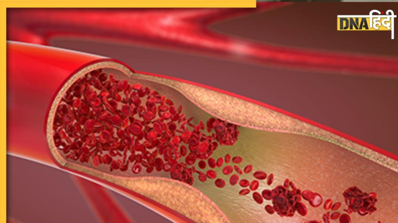 Blood Clotting Sign: ये संकेत बताते हैं नसों में गाढ़ा हो रहा है खून, हार्ट अटैक और स्ट्रोक का बढ़ जाता है खतरा