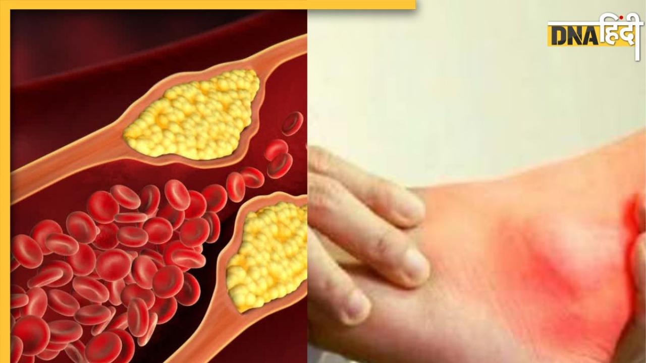 Cholesterol And Uric Acid: कोलेस्ट्रॉल और यूरिक एसिड को एक साथ कंट्रोल कर देंगी ये पांच चीजें, आज ही डाइट में कर लें शामिल