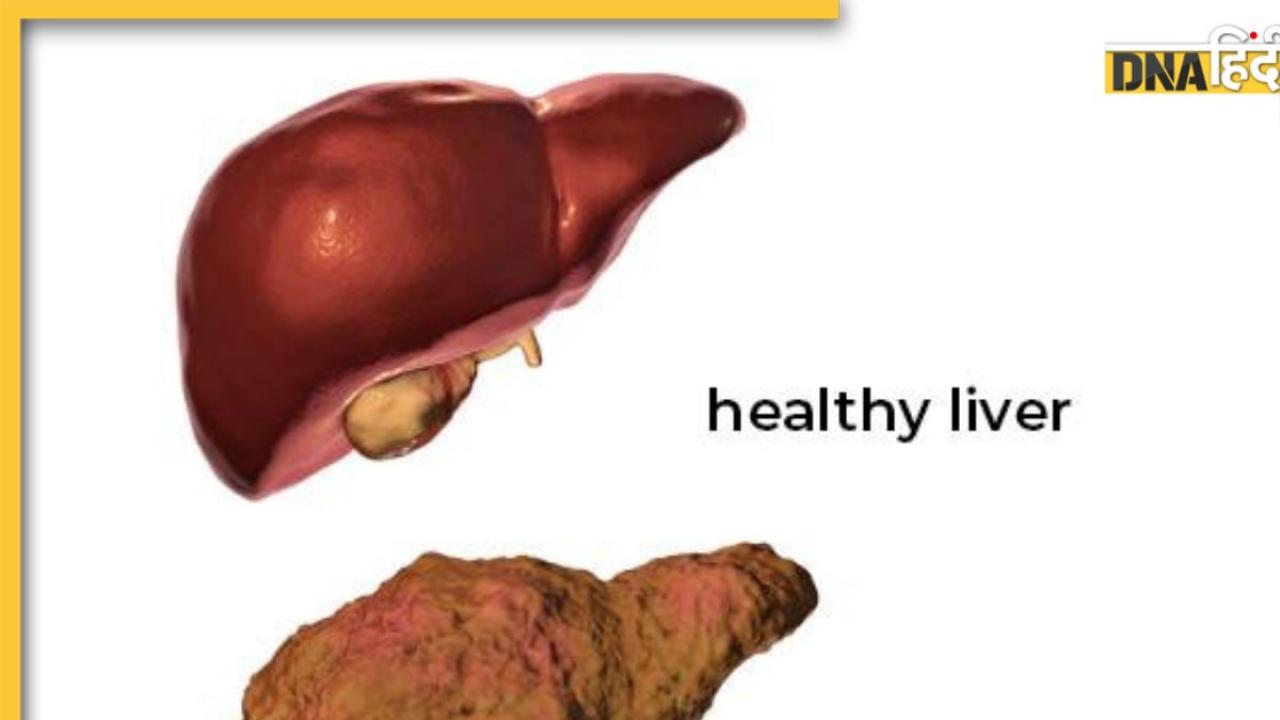 Liver Cirrhosis: लिवर सिरोसिस के हैं ये 7 चेतावनी संकेत जिन्हें नज़रअंदाज़ करना यानी मौत को दावत देना है