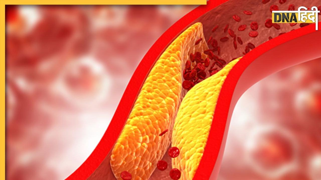 High Cholesterol Signs: धमनियों में जमा चिपचिपा पदार्थ बढ़ा देता है हार्ट अटैक का खतरा, इन लक्षणों के दिखते ही हो जाएं अलर्ट