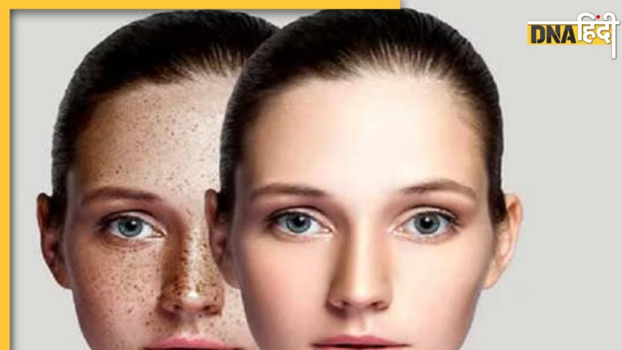 Dark Spots Caues: चेहरे पर पिंपल्स और दाग-धब्बों की वजह बनती हैं आपकी ये बुरी आदतें, तुरंत कर लें सुधार