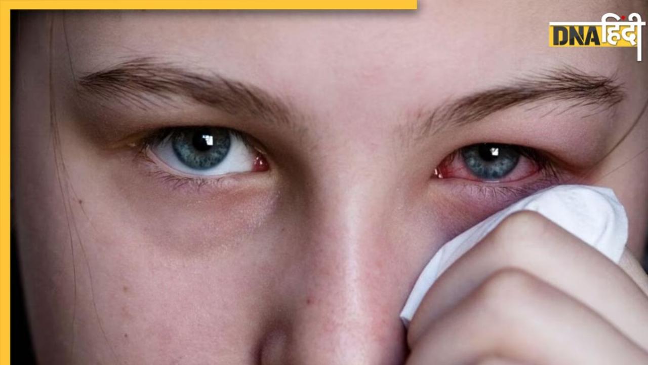 Eye Flu को क्यों कहते हैं पिंक आई? जानिए लक्षण, बचाव और इससे जुड़ी ये जरूरी बातें  