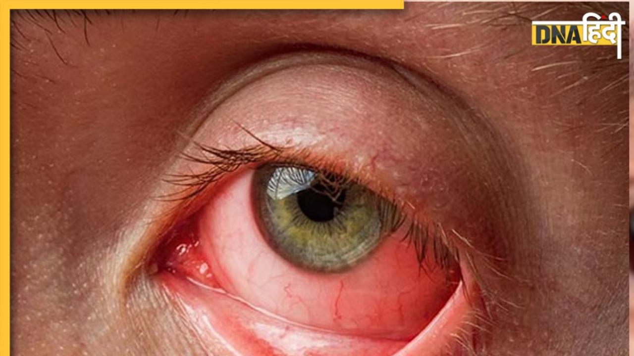 Eye Flu Remedy: आई फ्लू खत्म कर देंगे ये घरेलू नुस्खे, आंखों का संक्रमण रोकने का है ये रामबाण उपाय