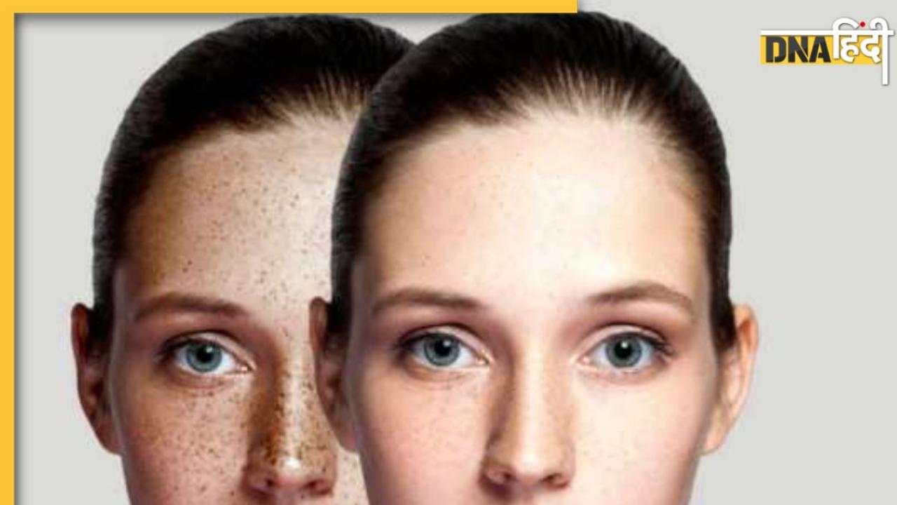 Home Remedy For Pigmentation: चेहरे पर पिगमेंटेशन से परेशान हैं? ट्राय करें ये घरेलू नुस्‍खे, हफ्तेभर में दिखेगा अंतर 