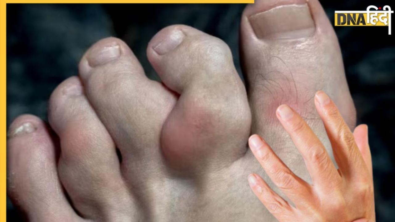 Arthritis Symptoms: इस बीमारी में मुड़ने लगते हैं पैर के अंगूठे, इन 6 लक्षणों को न करें इग्नोर  