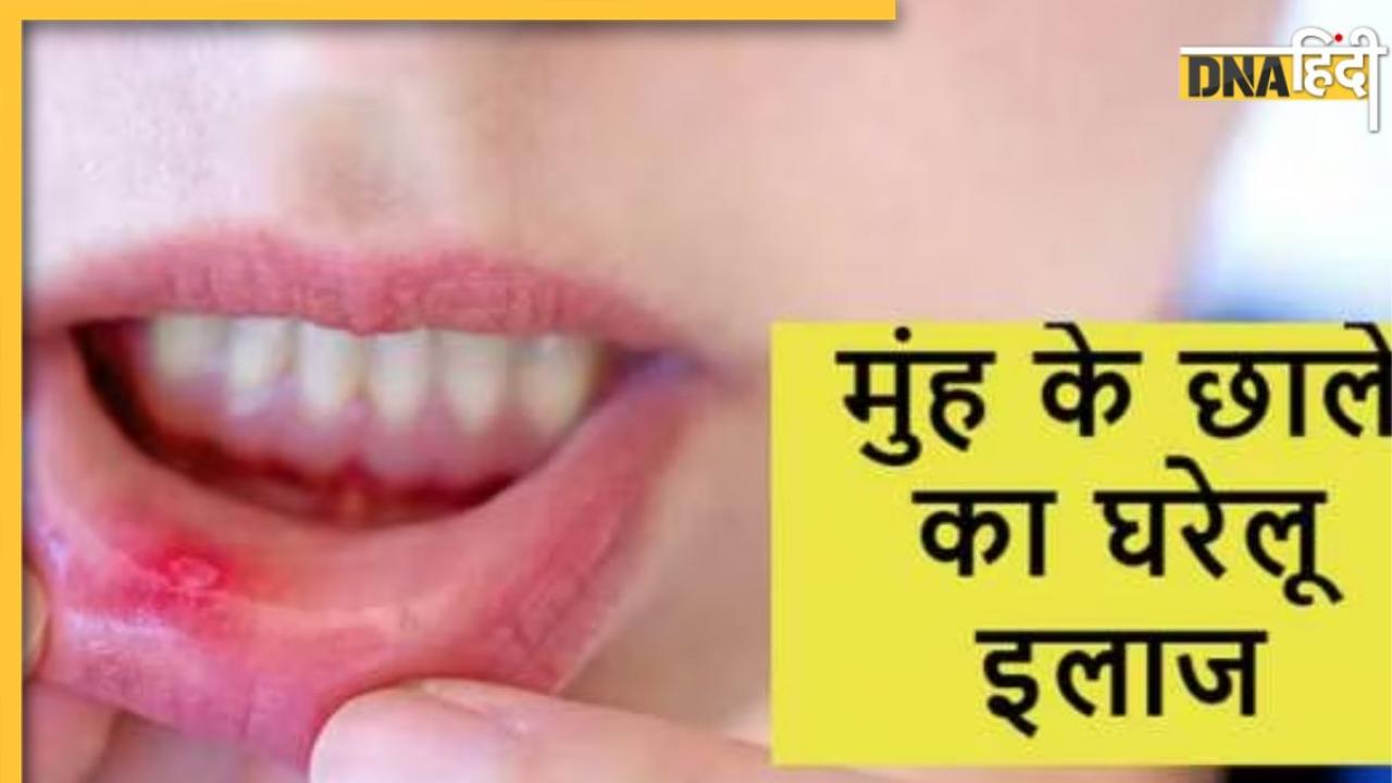 Mouth Ulcer Remedy: मुंह के छालों से मिनटों में मिलेगा आराम, आजमाकर देखें ये आसान घरेलू नुस्खा 