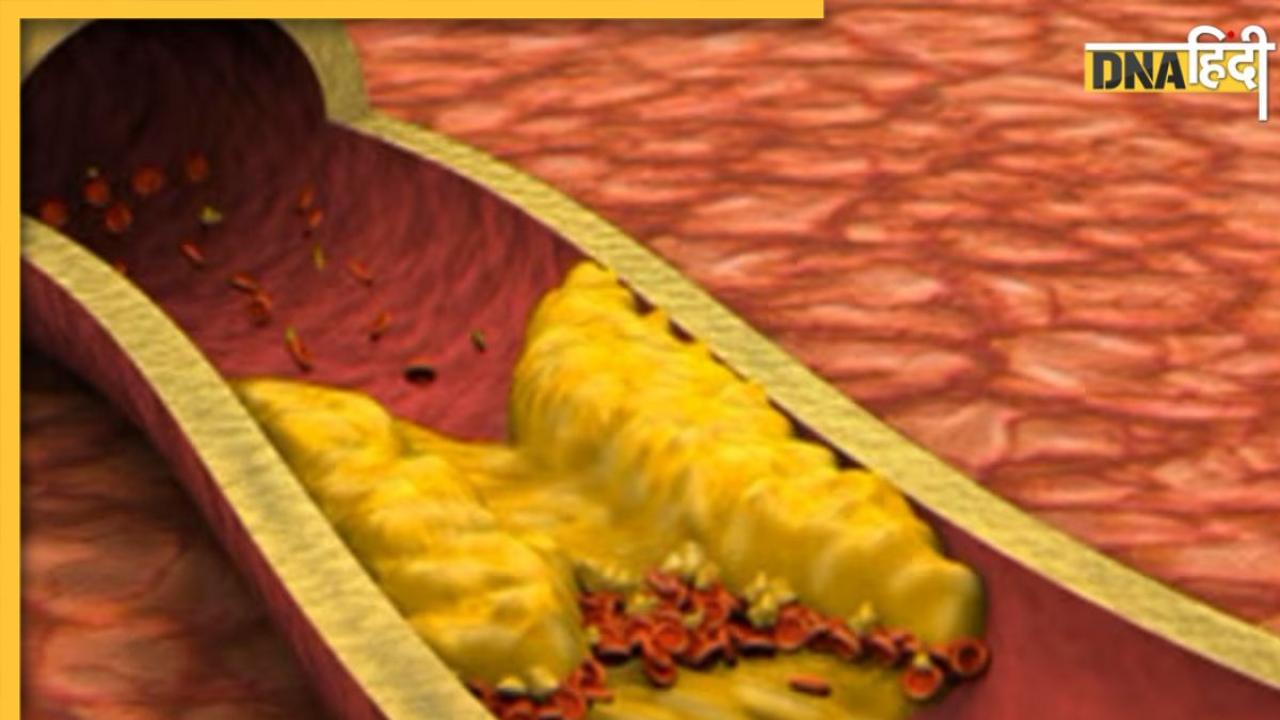 Bad Cholesterol Causes: ये 7 असामान्य चीजें नसों में भरती हैं फैट, शरीर में बढ़ता रहता है गंदा कोलेस्ट्रॉल 