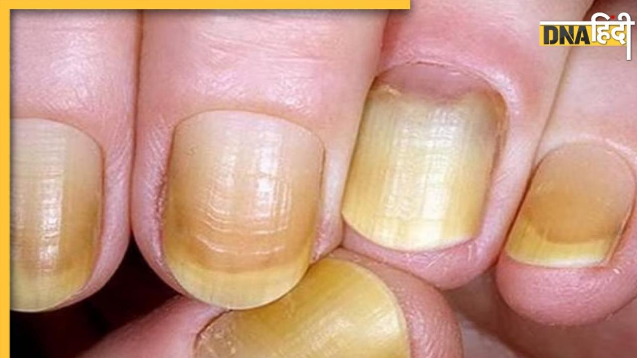 Yellow Nail Causes: पीले पड़ रहे हाथ-पैर के नाखून इन गंभीर बीमारियों के हैं संकेत, भूलकर भी न करें नजरंदाज 