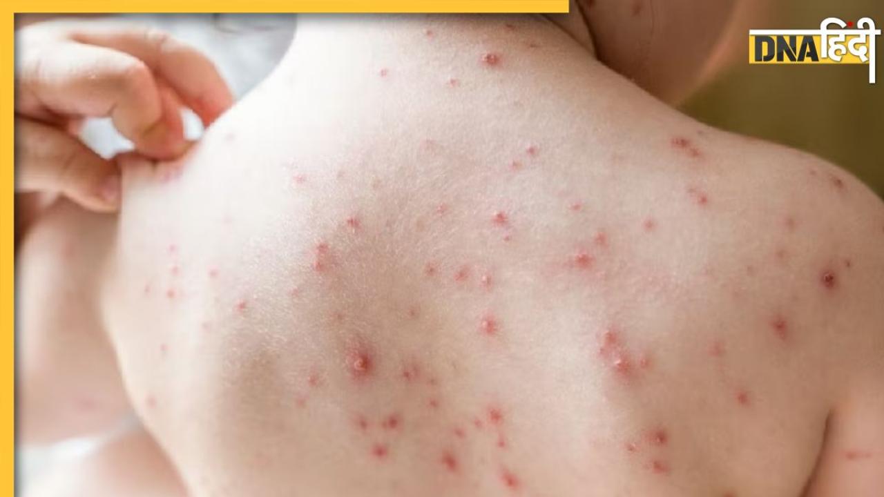 Chickenpox Clade 9: तेजी से फैल रहा चिकनपॉक्स का नया वेरिएंट, बच्चों के लिए खतरनाक, जानें इसके लक्षण और बचाव