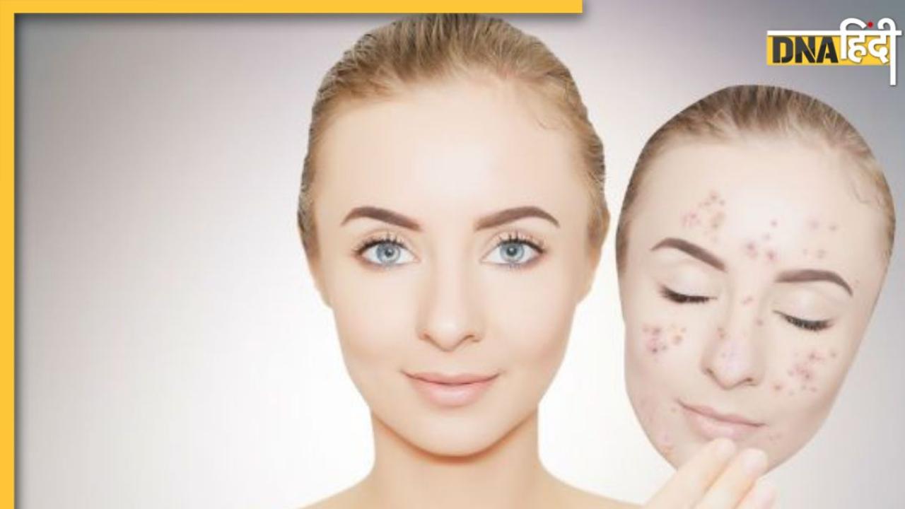 Dark Spots Removal Tips: चेहरे पर दाग-धब्बों से कम हो रही है खूबसूरती, इन आसान उपायों से दूर होगी समस्या