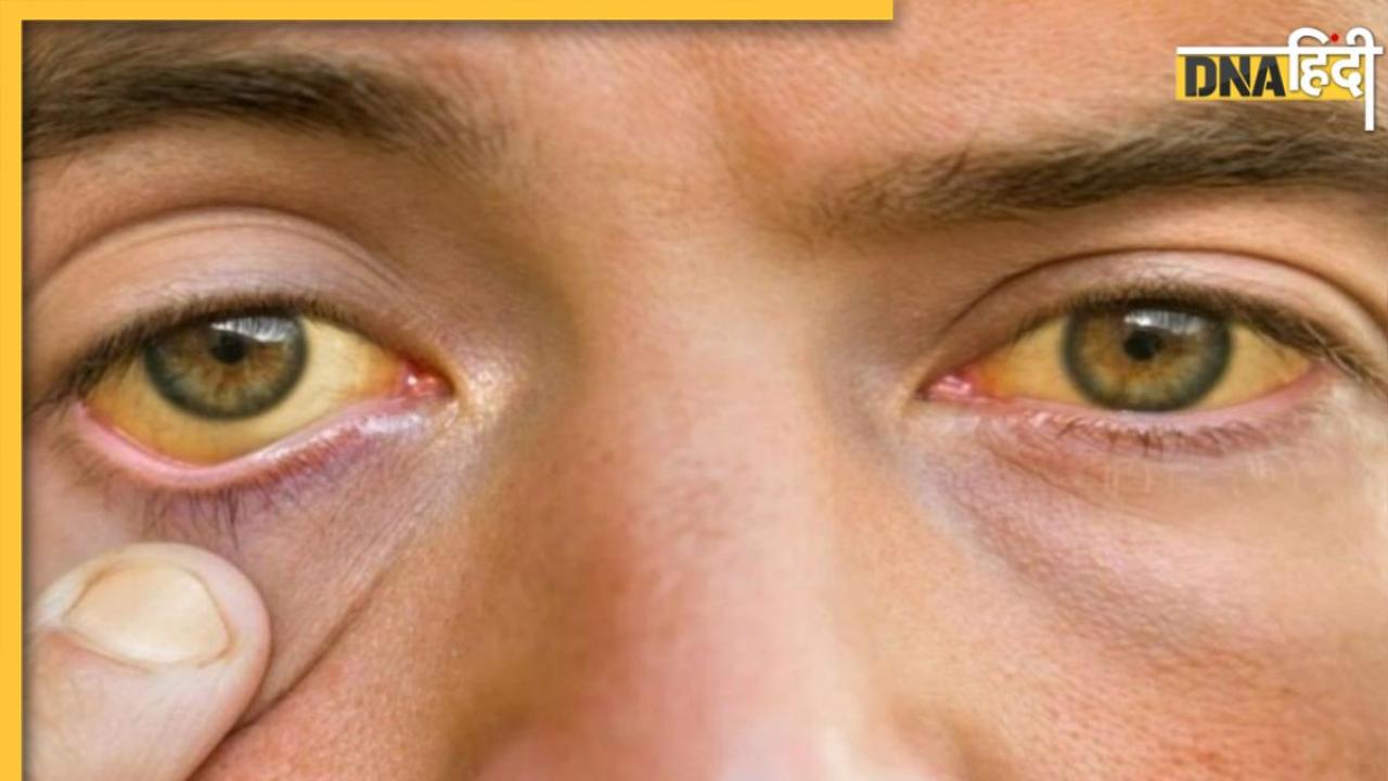Cholesterol Causes: शरीर में जमा कोलेस्ट्रॉल छीन सकती है आंखों की रोशनी, इन लक्षणों को न करें इग्नोर