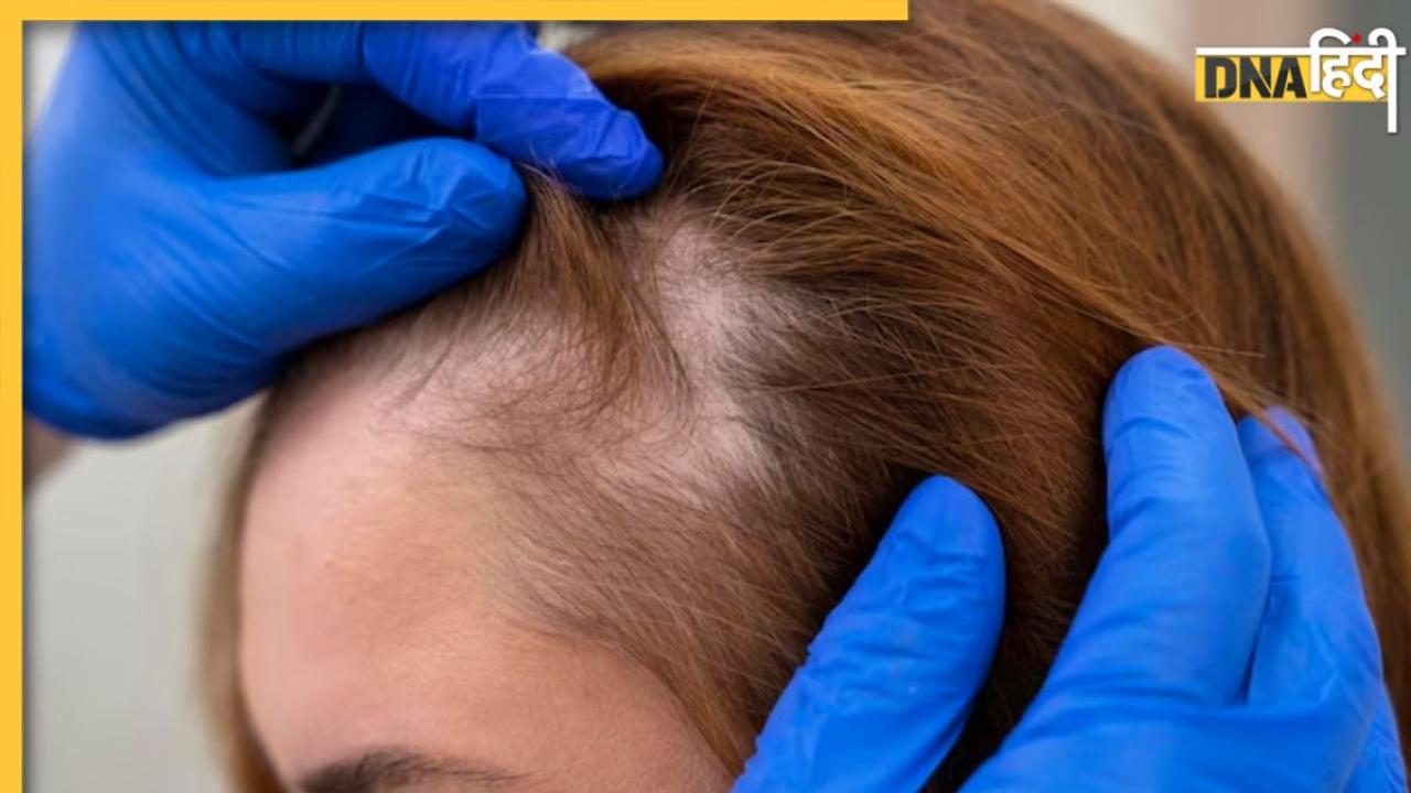 Hair Fall Causes: हल्के में न लें बालों का झड़ना, इन बीमारियों के कारण भी तेजी से गिरते हैं बाल 