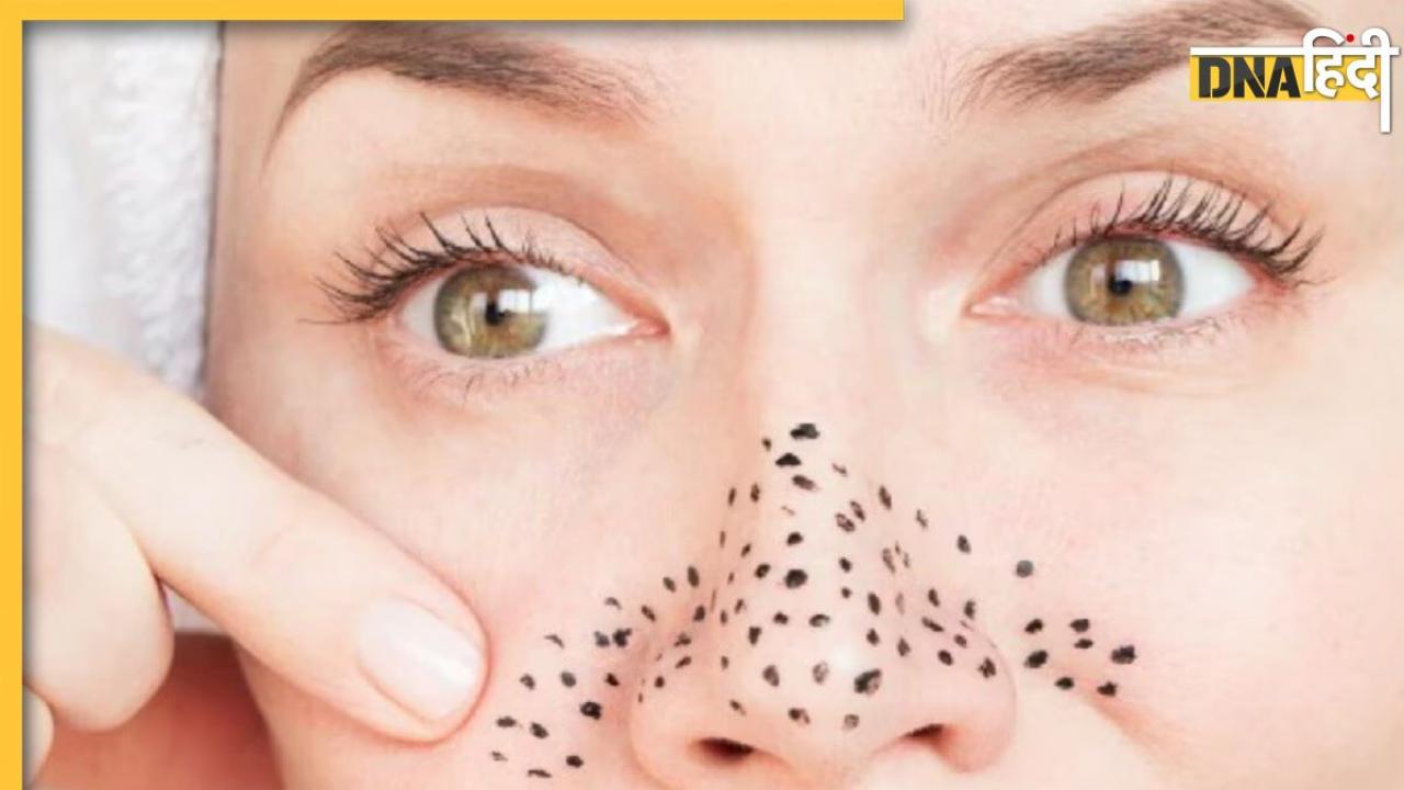 Blackheads Remove Tips: नाक पर जमा हो गए हैं ब्लैकहेड्स तो न हो परेशान, इन देसी ट्रिक से मिल जाएगा छुटकारा