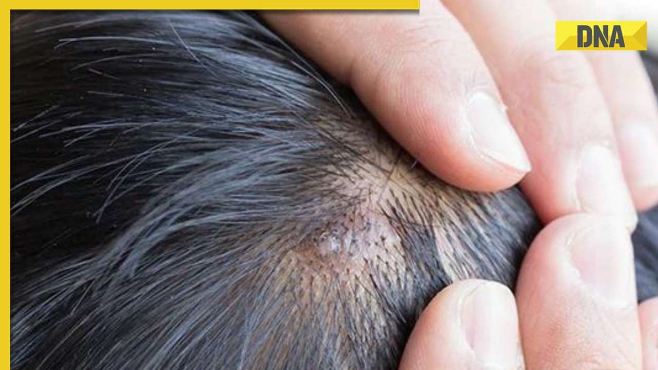 Do you have acne on scalp? Here's how to get rid of them