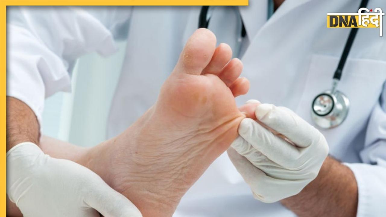 Diabetes Feet Care: सर्दी में डायबिटीज मरीजों के पैरों में दिखने वाले ये लक्षण देते हैं हाई ब्लड शुगर के संकेत, जानें पहचान और उपचार