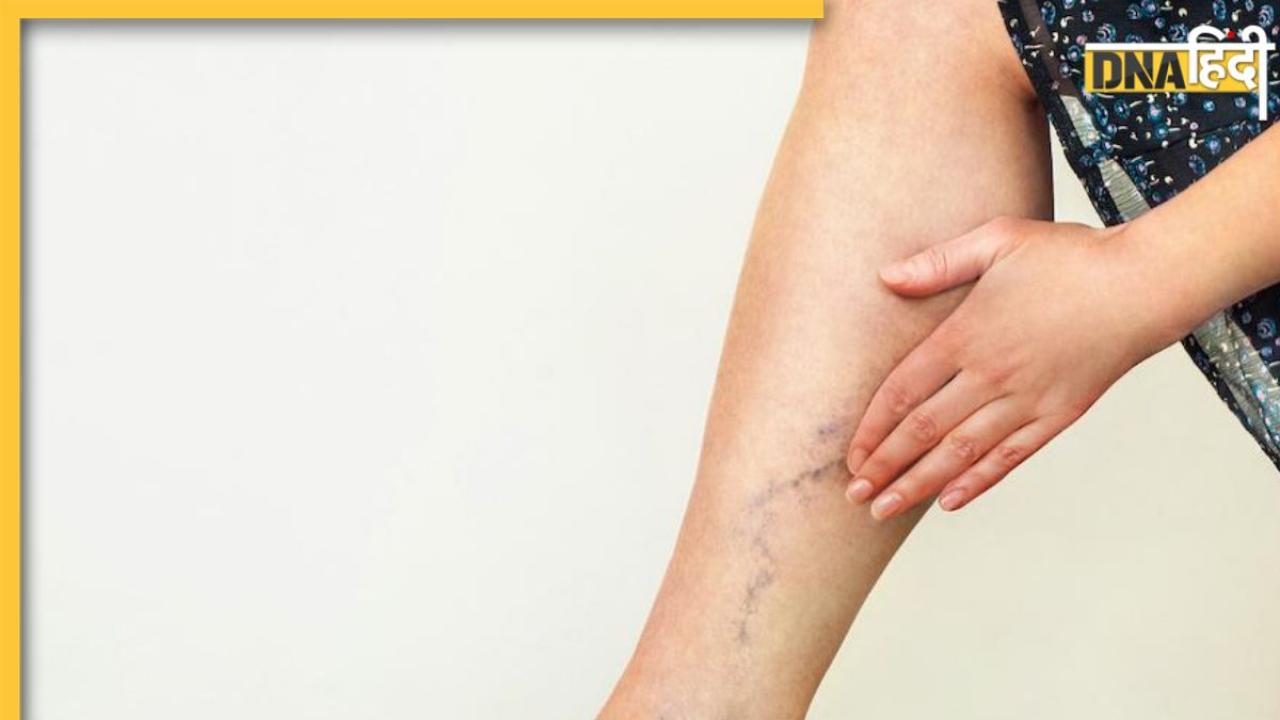 Varicose Veins: क्या है वैरिकोज वेन्स? जिससे फूलने लगती हैं हाथ-पैर की नसें, जानें लक्षण