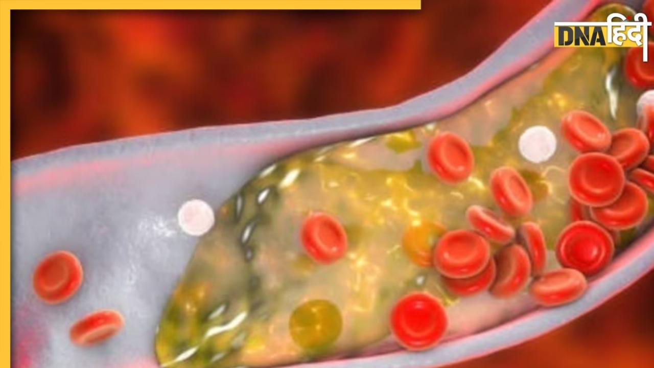 Bad Cholesterol Effects: दिल के लिए घातक होता है बैड कोलेस्ट्रॉल, साइलेंट तरीके से जान ले लेती है यह बीमारी, ऐसे करें  बचाव