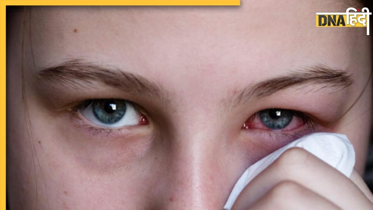 Eye Infection: जहरीली हवा आंखों को भी कर रही प्रभावित, इन उपायों से करें जलन और सूजन से बचाव