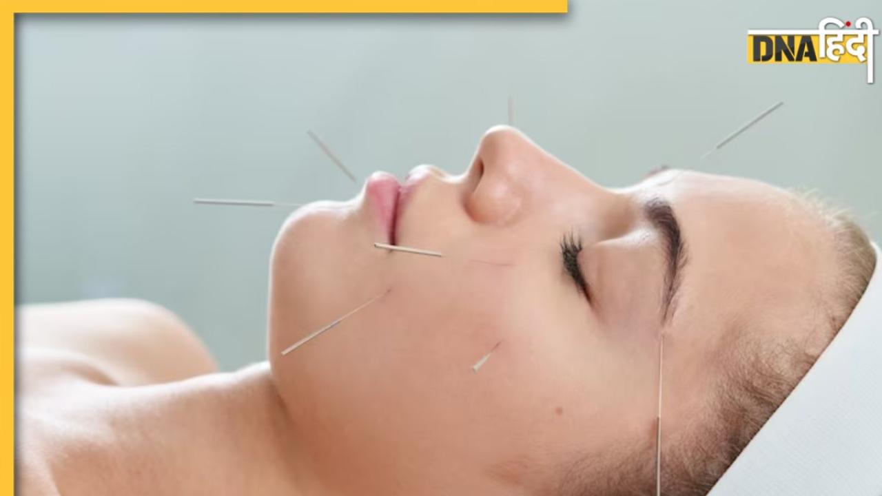 Acupuncture Therapy: क्या है एक्यूपंक्चर थेरेपी? शरीर में सुईयां चुभा कर किया जाता है बीमारियों का इलाज 