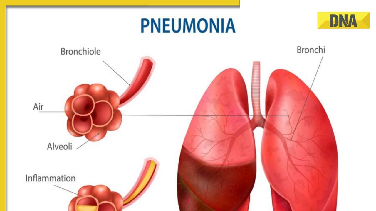 Explained: Mysterious pneumonia outbreak in China; Know symptoms, WHO guidelines