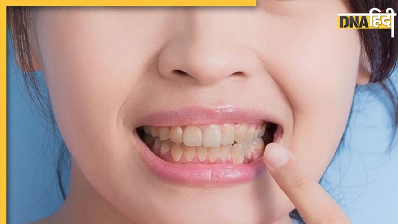 Yellow Teeth Whitening Remedies: दांतों पर जमी पीली परत को हटाने के लिए अपनाएं ये घरेलू उपाय, मुंह की दुर्गंध भी होगी दूर