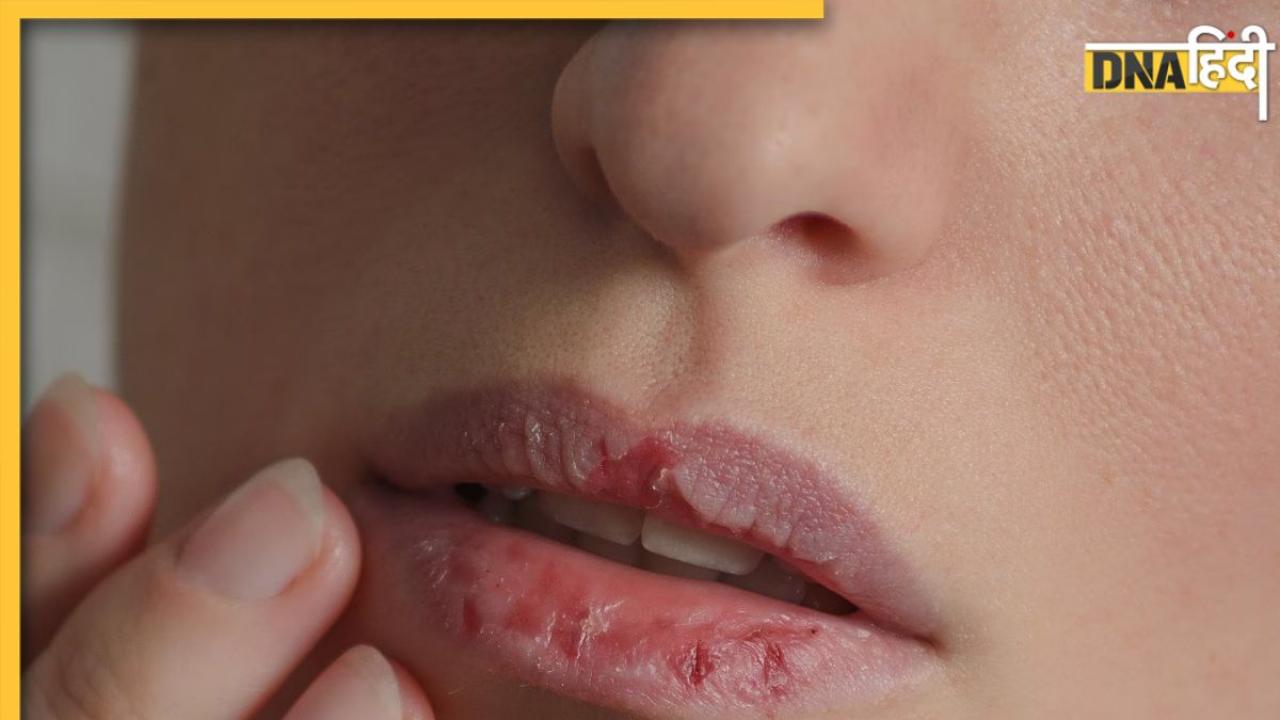 Dry Lips Care: सर्दियों में फट रहे हैं होंठ तो लिप केयर के लिए फॉलो करें ये 6 टिप्स, मुलायम और खूबसूरत रहेंगे होंठ