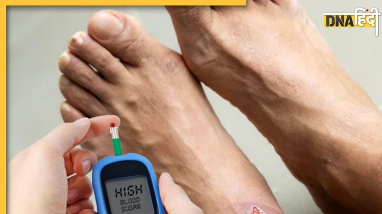 Diabetic Foot Ulcer: डायबिटीज मरीज पैरों के घाव और छालों को न करें नजरअंदाज, हो सकता है गंभीर संक्रमण
