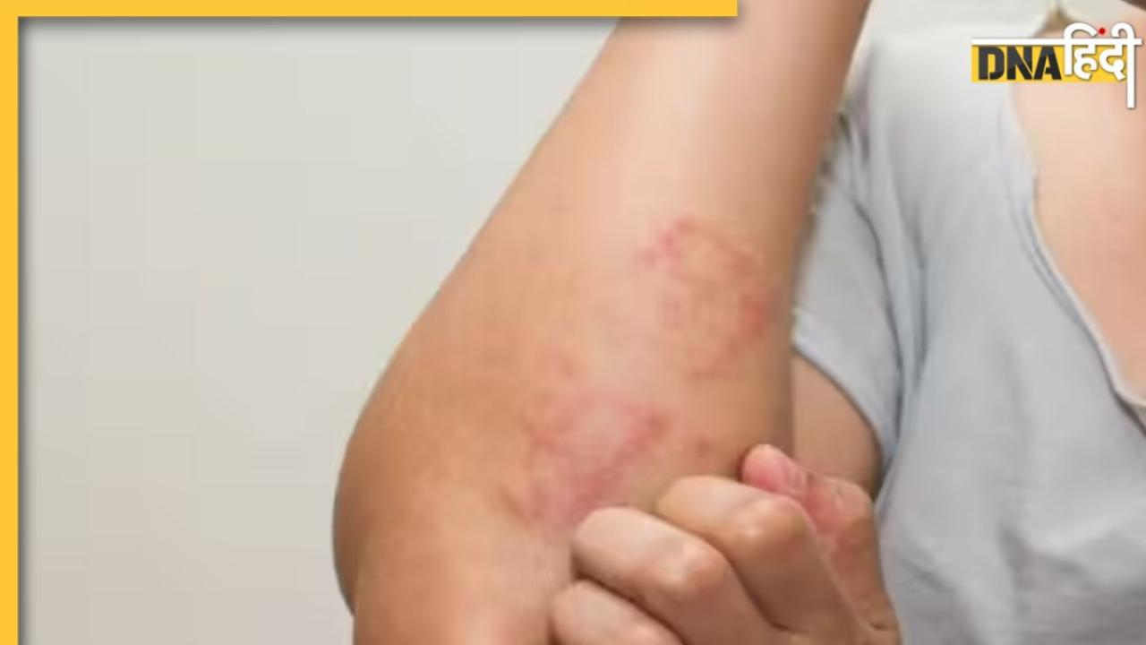 Dermatitis Symptoms: त्वचा पर फफोले-खुजली समेत ये लक्षण हैं डर्मेटाइटिस के संकेत, तुरंत कराएं इलाज