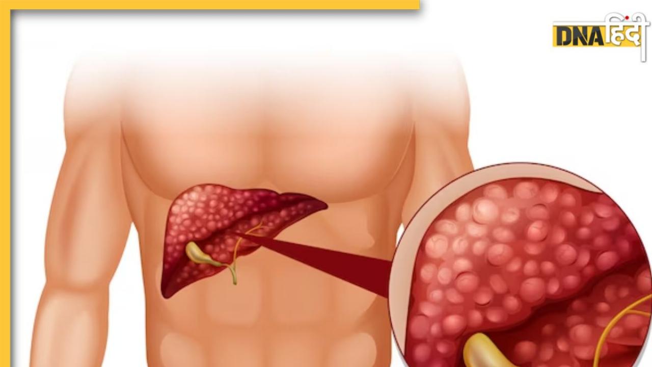 Liver Cirrhosis And Diabetes: शुगर हाई रहने से अंदर ही अंदर सड़ने लगता है लिवर, ये लक्षण दिखें तो तुरंत कराएं जांच