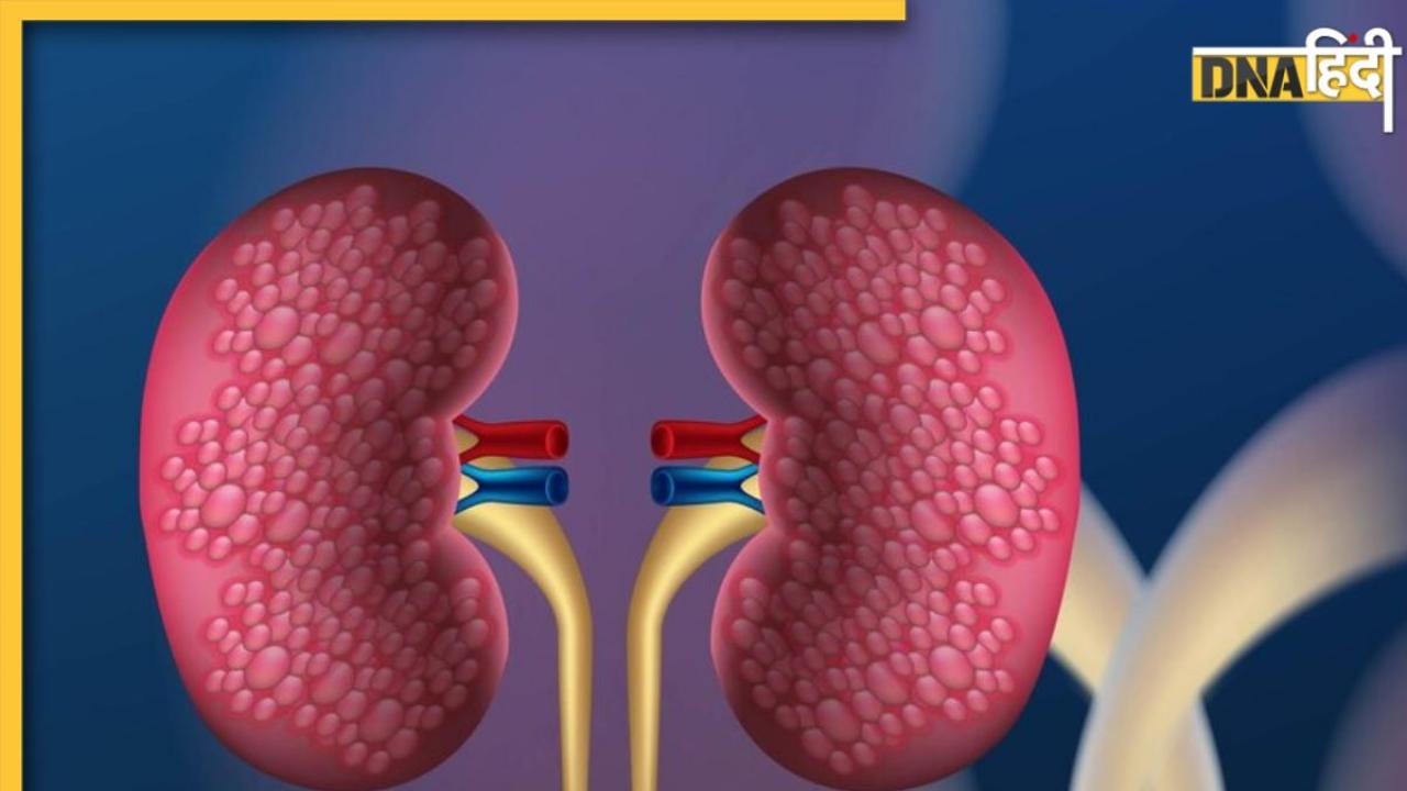 Polycystic Kidney Disease: क्या है पॉलीसिस्टिक डिजीज, जिससे किडनी में बन जाता है अल्सर, जानें लक्षण और बचाव के उपाय