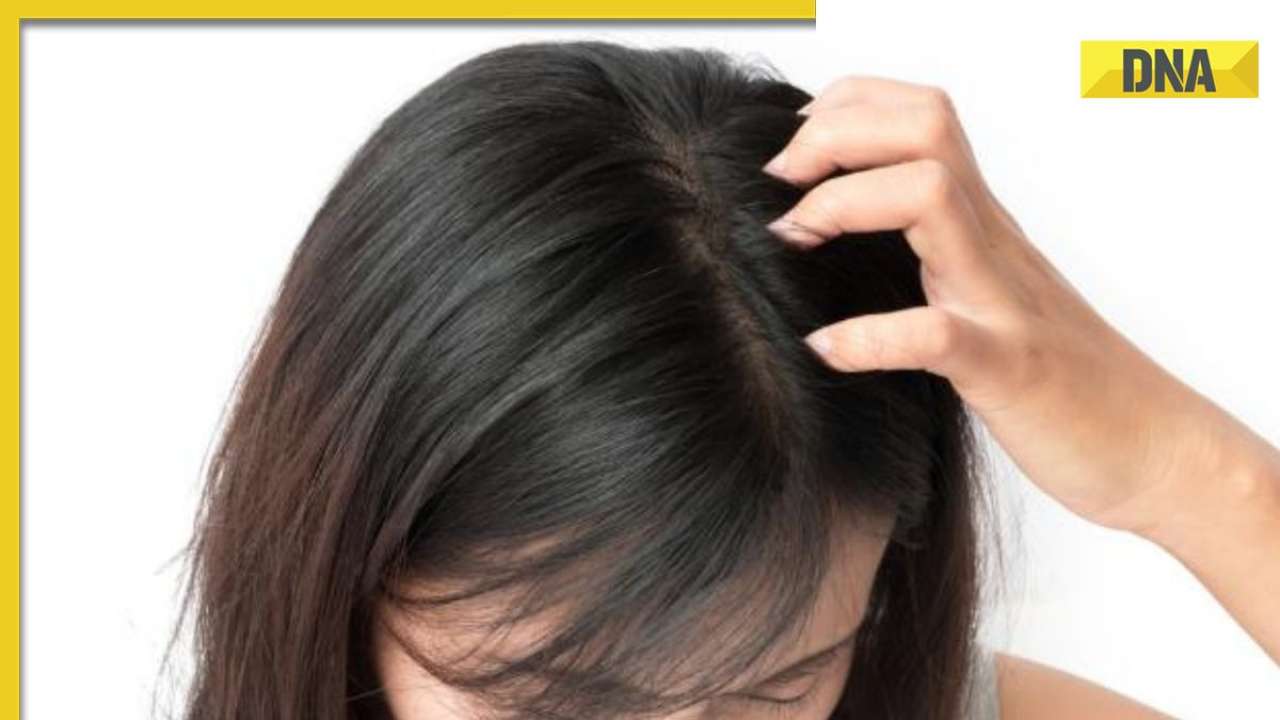Dandruff in winter: 5 Ayurveda remedies to treat dry and flaky scalp naturally 
