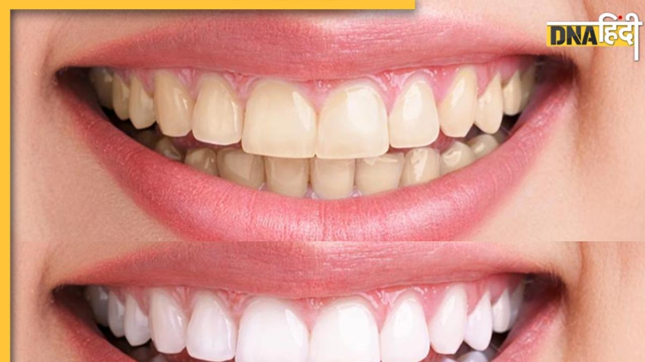 Teeth Whitening Remedies: रोज ब्रश करने के बाद भी नहीं हटता दांतों पर जमा जिद्दी पीलापन, इन उपायों से चमकेगी बत्तीसी