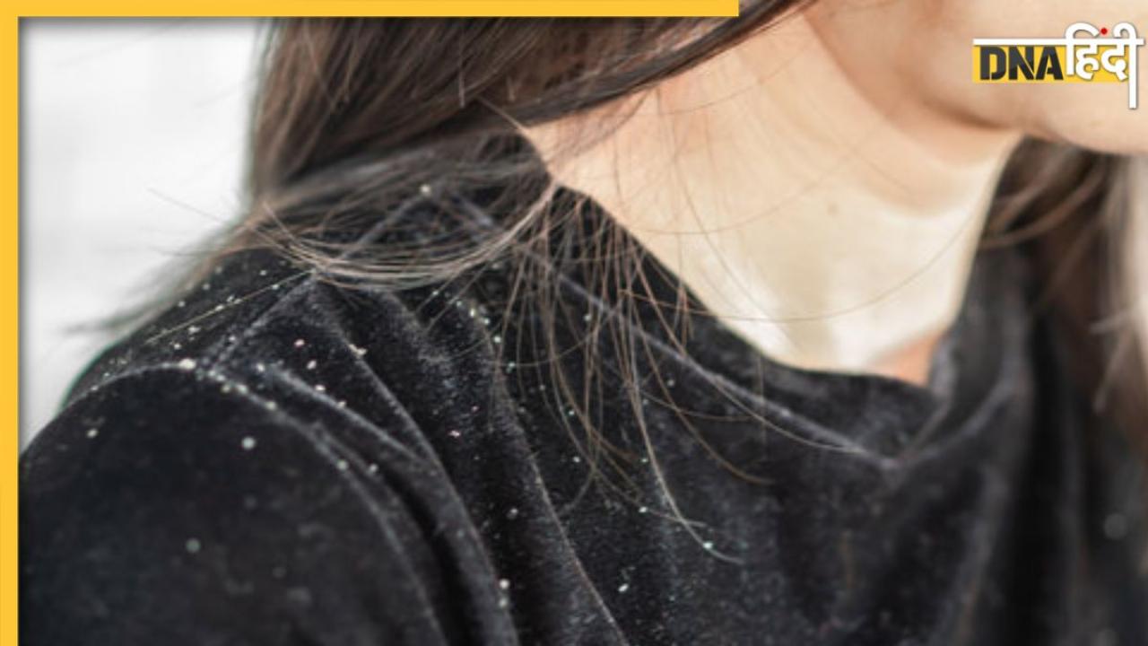 Dandruff Remedies: स्नोफॉल की तरह झड़ रहा है डैंड्रफ, सिर में लगाएं इनमें से कोई एक चीज और देखें असर