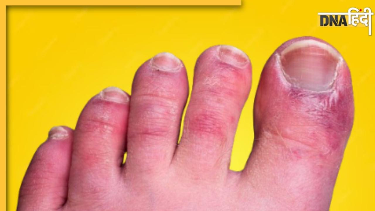 Blisters Itchiness Causes: ठंड में हाथ-पैर में खुजली और जलन इस गंभीर बीमारी की ओर करता है इशारा, न करें अनदेखा