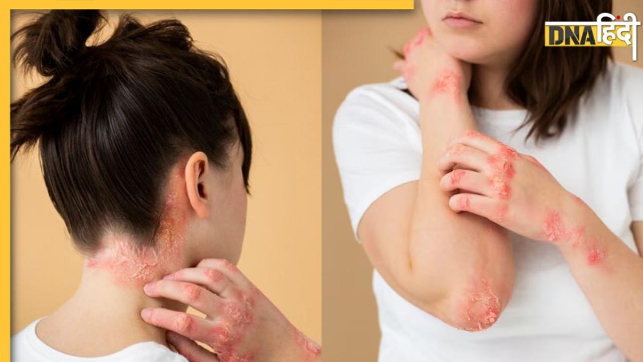 Winter Skin Diseases: त्वचा पर लाल दाने-खुजली स्किन की इन बीमारियों के हैं संकेत, बचाव के लिए तुरंत करें ये काम