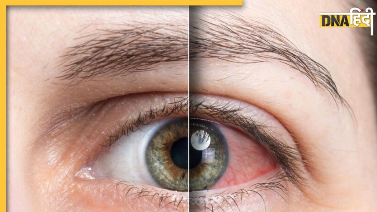 Glaucoma Symptoms: क्या है ग्लूकोमा? आंखों की रोशनी छीन अंधा बना सकती है ये बीमारी, लक्षण दिखते ही कराएं जांच