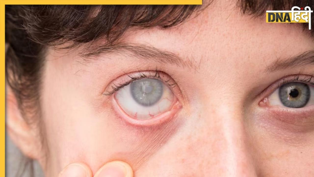 Eye Diseases: आंखों की रोशनी छीन लेने वाली इस बीमारी के नहीं दिखते लक्षण, ये लोग रहें सावधान