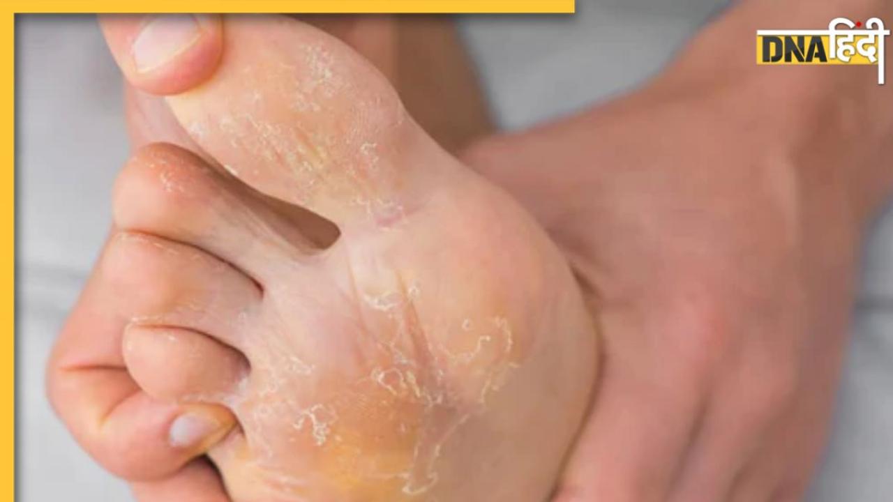 Foot Fungal Infection Remedy: पैरों में फंगल इन्फेक्शन की समस्या से हैं परेशान? अपनाकर देखें ये कारगर नुस्खे, जल्द मिलेगी राहत