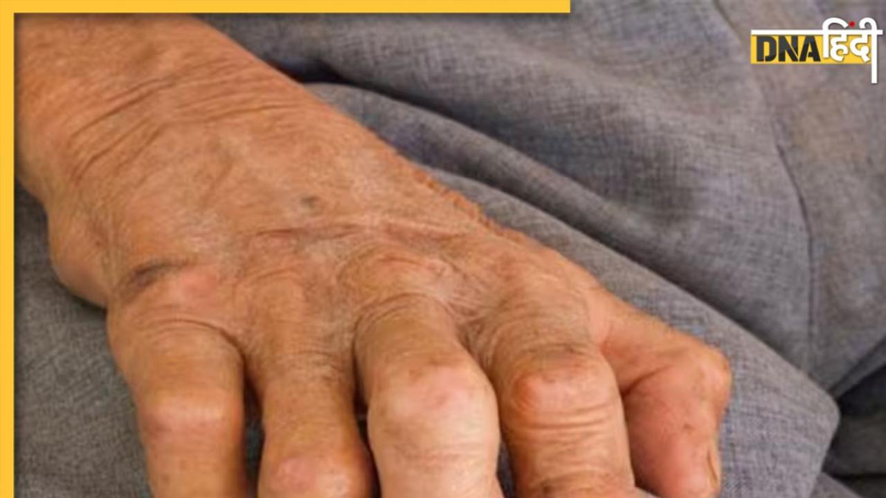 World Leprosy Day 2024: आनुवांशिक या छुआछूत की बीमारी नहीं है कुष्ठ रोग, जानें क्या है इसका इलाज और बचाव के उपाय