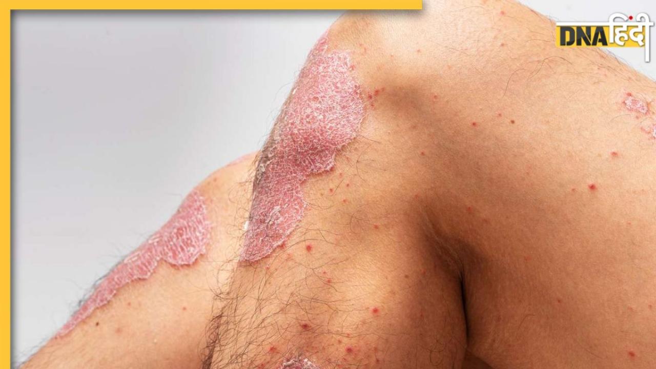 Red Patches On Skin: शरीर के इन हिस्सों में लाल पैच इस गंभीर बीमारी के हो सकते हैं संकेत, लक्षण दिखते ही कराएं जांच